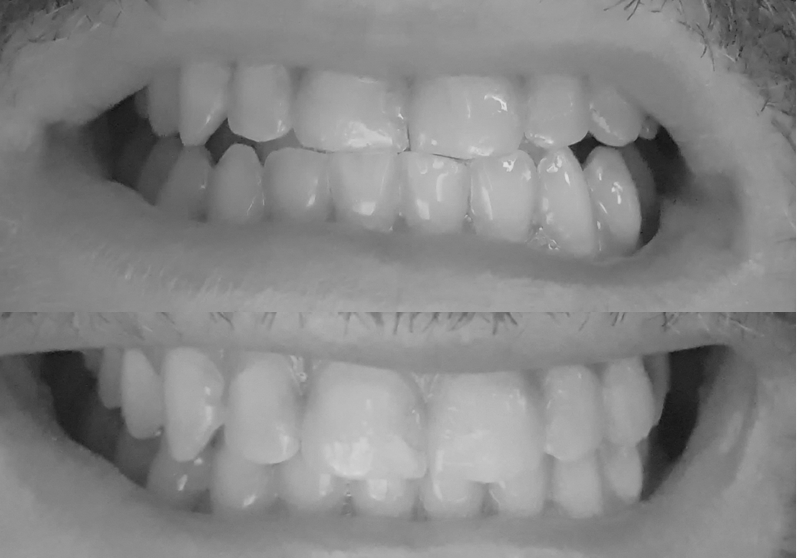Picture of my biting before and after Before After