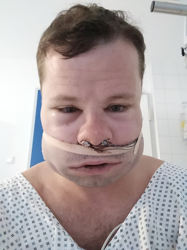 Day 2 after operation