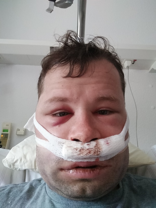 Day 3 after the surgery
