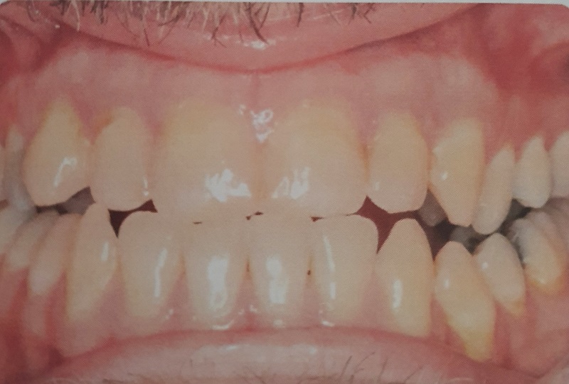 Picture of me before the surgery